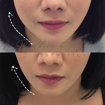 Facial Slimming - Facial Aesthetic Treatment